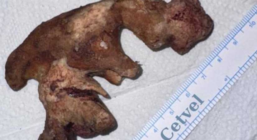 Böbreğinden 10 santimlik taş çıktı